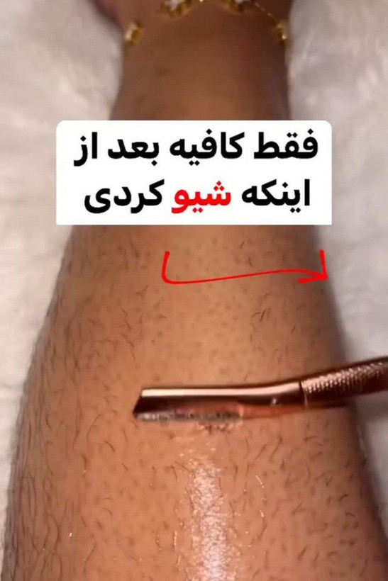 اسپری جلوگیری از رشد موی زائد Sadoer (حاوی روغن مورچه )