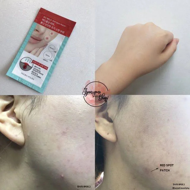 پچ ضد جوش هیدروکلوئید Karité مدل AC MILD Red Spot Patch
